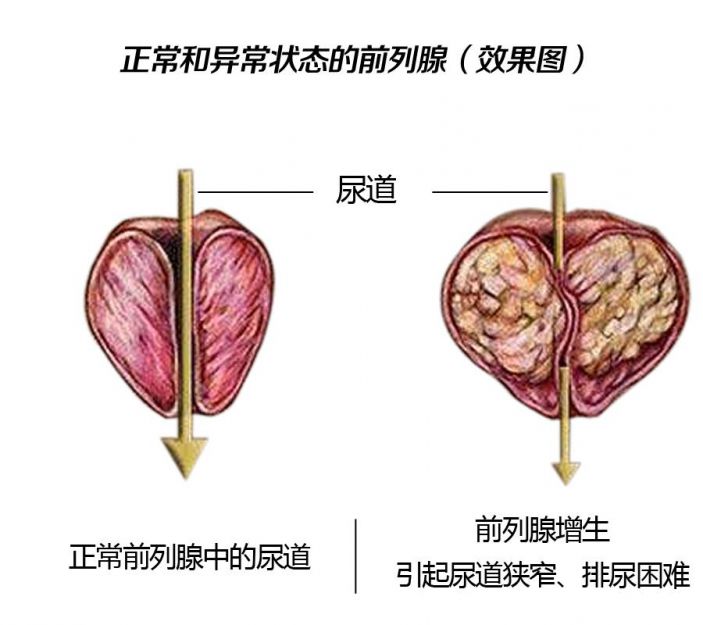 排尿困难、尿不出，很可能是前列腺增生惹的祸