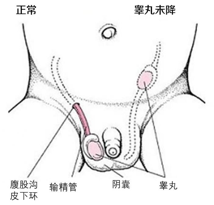 “天生”仅一个睾丸该怎么办？